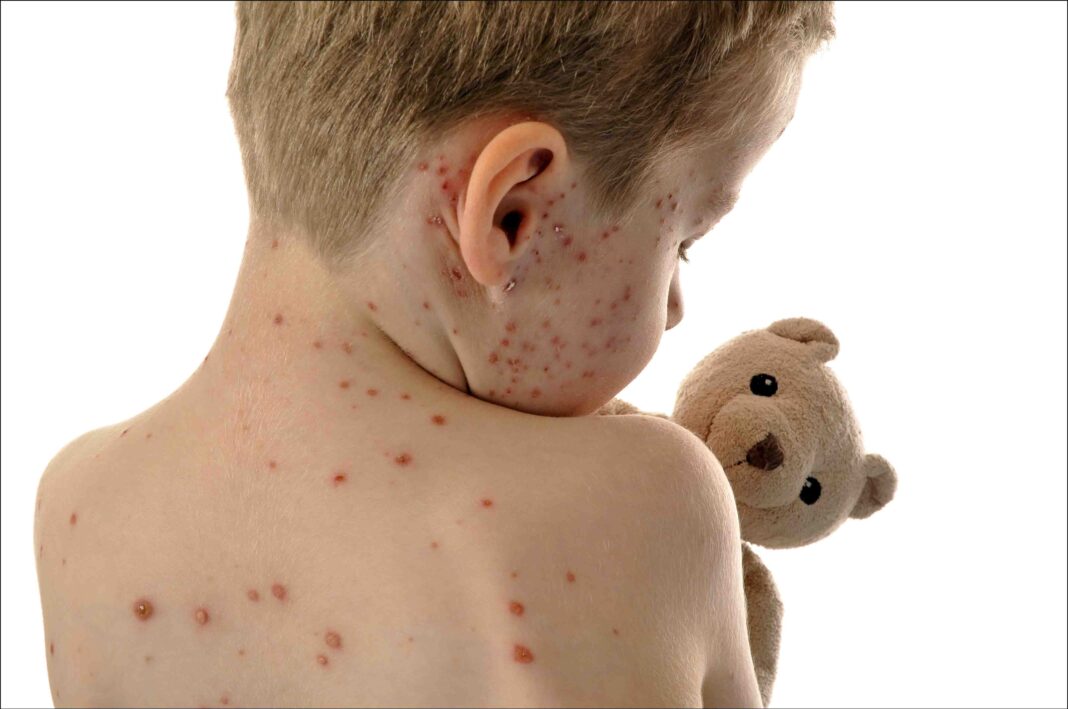 Samoa’s health ministry plans to increase measles immunisation rates. Samoa’s health ministry plans to increase measles immunisation rates.