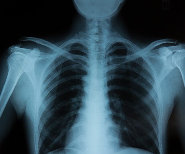 <strong>Revolutionary new drug offers hope to children with bone Cancer</strong> <strong>Revolutionary new drug offers hope to children with bone Cancer</strong>