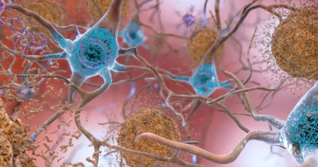 Gene silencing’ drug may offer new hope for Alzheimer’s disease Gene silencing’ drug may offer new hope for Alzheimer’s disease