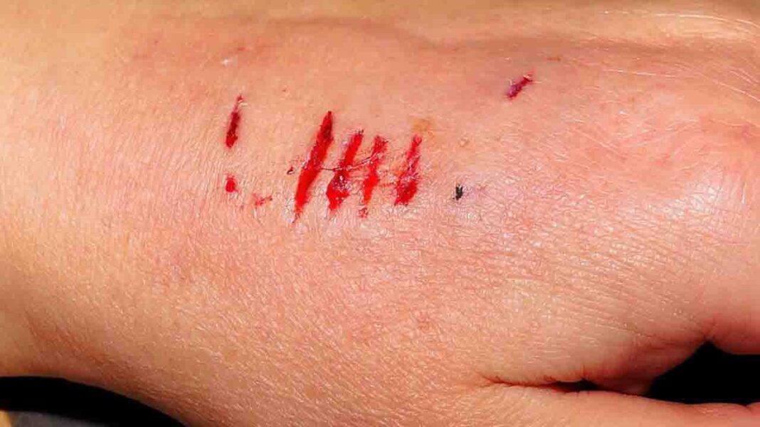 What has bioactive glass got to do with wounds? What has bioactive glass got to do with wounds?