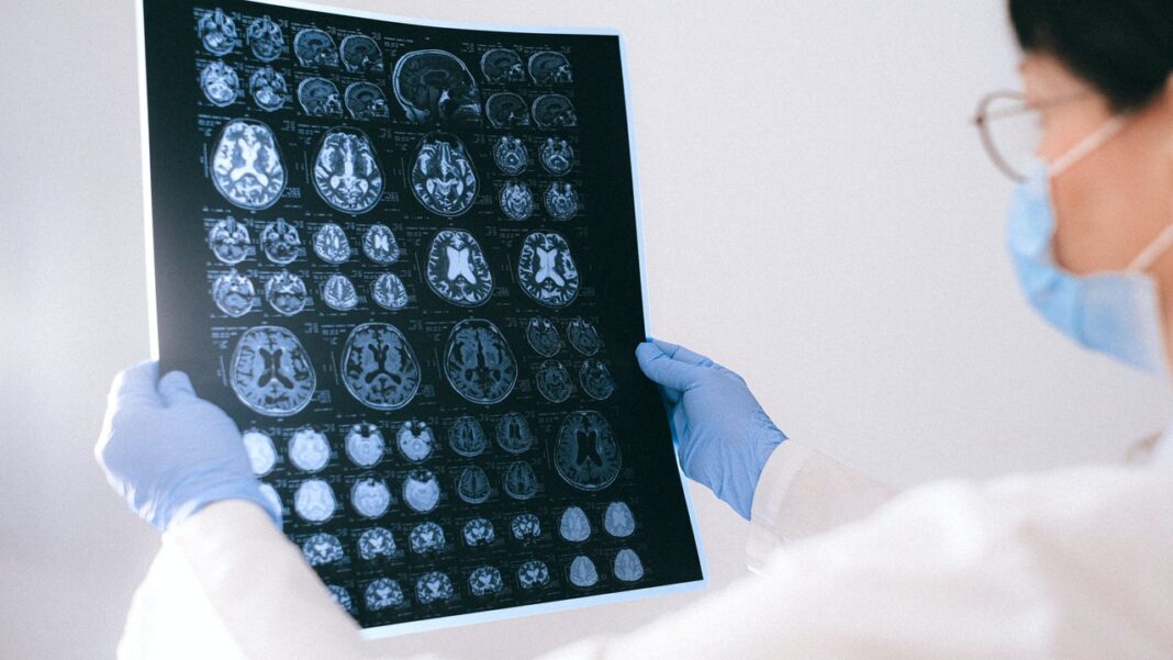 Sleep brain waves in epilepsy Sleep brain waves in epilepsy