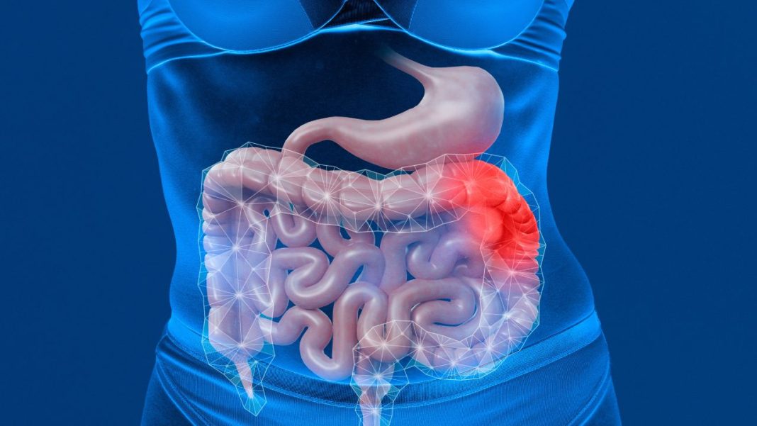 Disturbing upsurge in colorectal cancer cases Disturbing upsurge in colorectal cancer cases