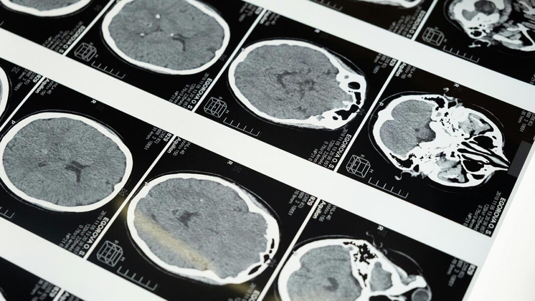 Patients may be conscious during a coma Patients may be conscious during a coma