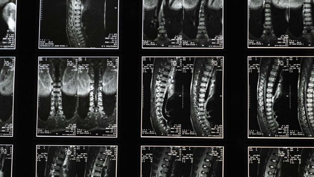 Scientists find hip implant materials with the lowest risk of needing revision Scientists find hip implant materials with the lowest risk of needing revision