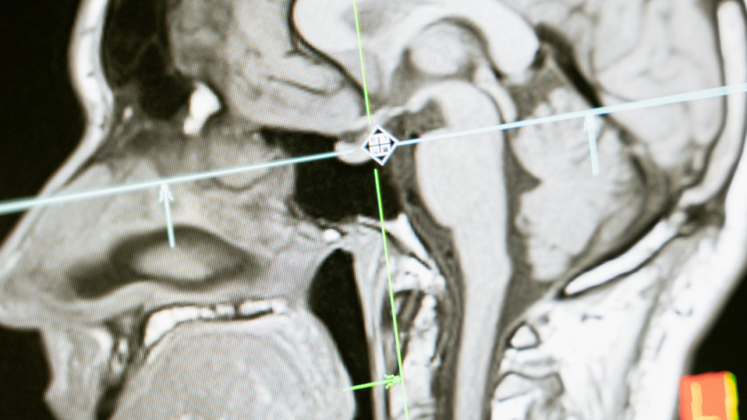 AI Cracks Open Hidden Hospital Data to Reveal Shocking MS Insights