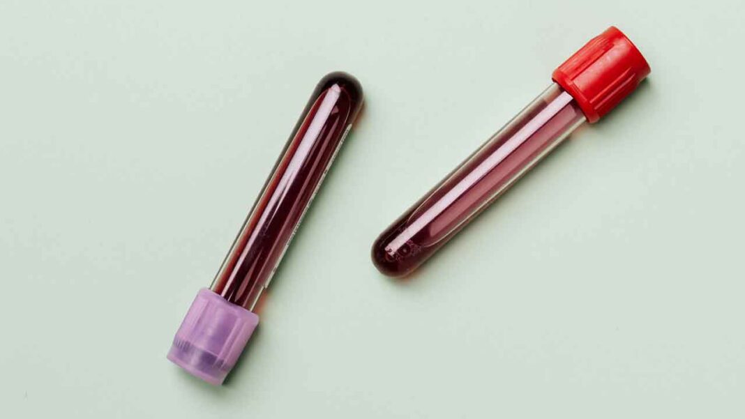 Revolutionary Blood Test Tracks Clots in Real Time—Is This the End of Strokes? Revolutionary Blood Test Tracks Clots in Real Time—Is This the End of Strokes?
