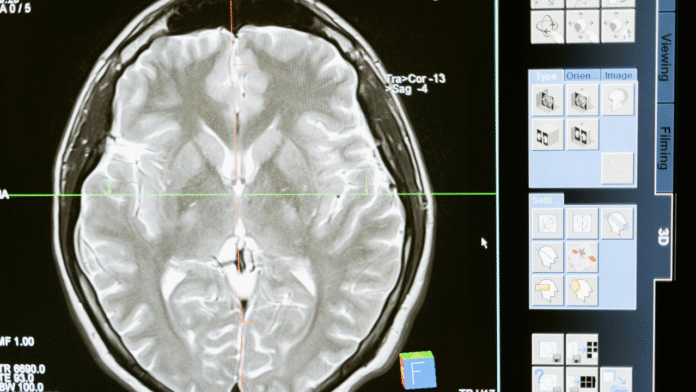 Scientists Find Alzheimer’s May Begin in the Brain’s Secret Guardians