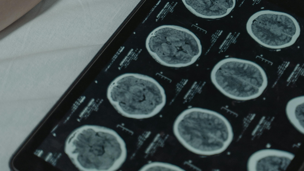 Faster, Cheaper, Smarter: The MRI Breakthrough That Could End the Dementia Diagnosis Gap Faster, Cheaper, Smarter: The MRI Breakthrough That Could End the Dementia Diagnosis Gap