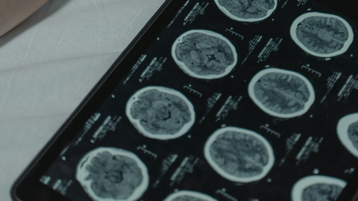 Faster, Cheaper, Smarter: The MRI Breakthrough That Could End the Dementia Diagnosis Gap
