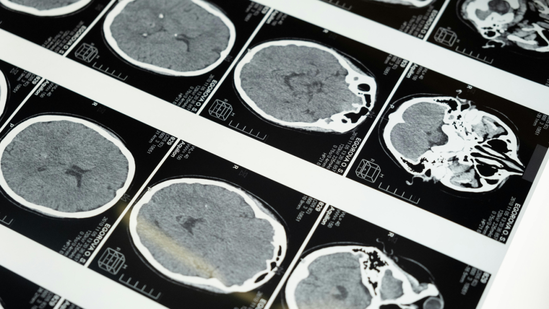 From Brain Mapping to Parkinson’s Cure: How Scientists Are Redefining Cell Therapy Research From Brain Mapping to Parkinson’s Cure: How Scientists Are Redefining Cell Therapy Research