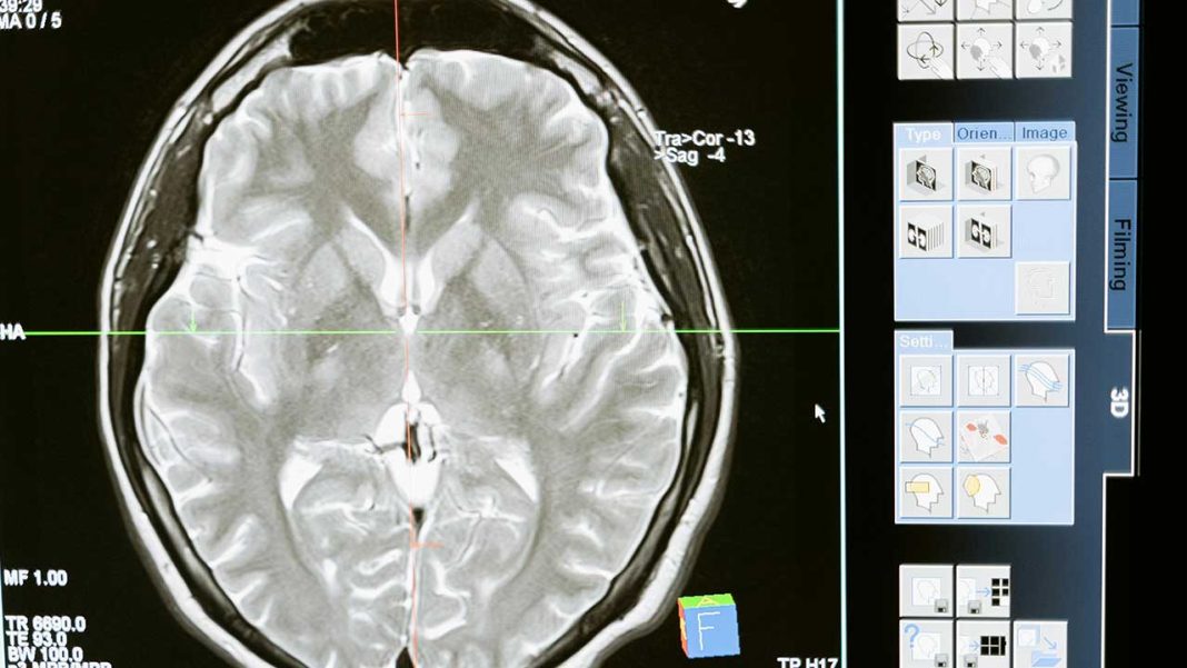 From Fertility to Cancer Survival: How PRDM9 Helps Glioblastoma Return After Treatment From Fertility to Cancer Survival: How PRDM9 Helps Glioblastoma Return After Treatment