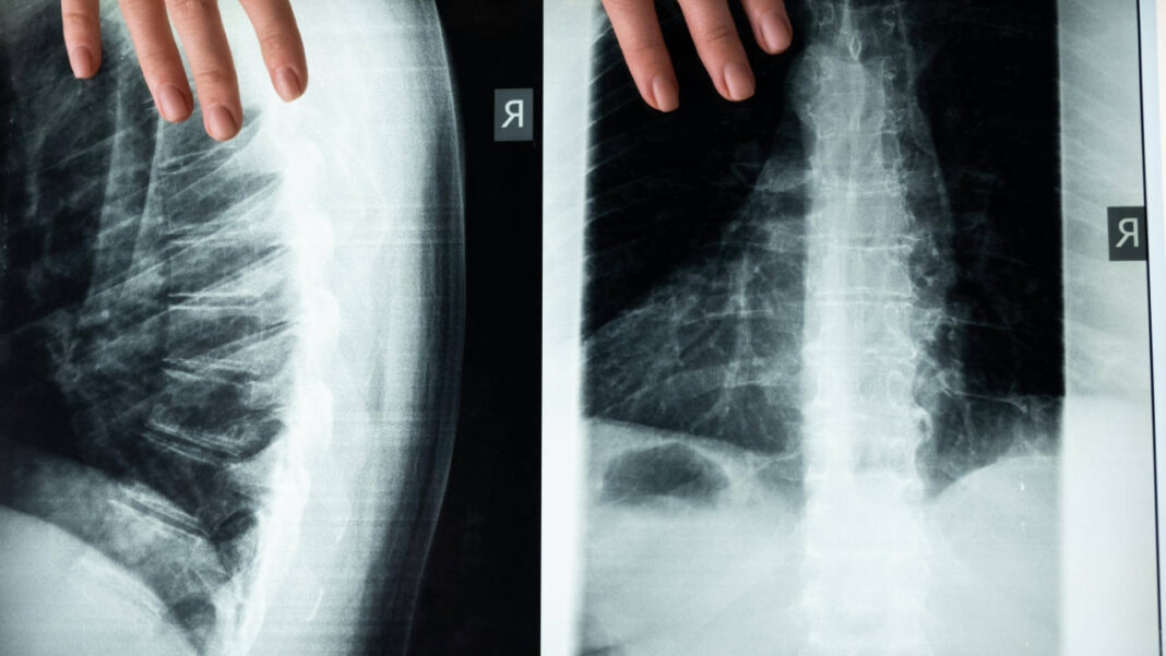 Are ‘Dancing Molecules’ the Future of Spinal Cord Injury Treatment? Human Organoid Study Offers Strong Evidence Are ‘Dancing Molecules’ the Future of Spinal Cord Injury Treatment? Human Organoid Study Offers Strong Evidence