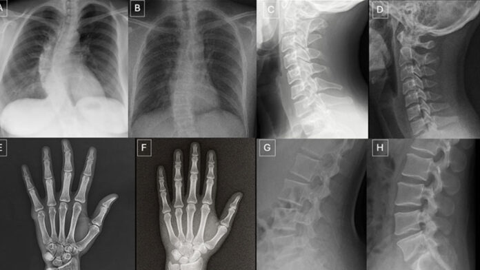 Deepfake Medical Images: Why Even Radiologists and AI Models Can’t Reliably Detect Fake X-Rays