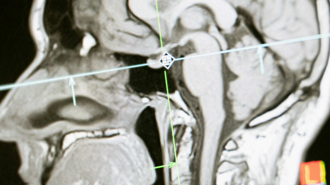 Can Non-Invasive Ultrasound Rewire Emotion Processing? Study Points to the Amygdala Can Non-Invasive Ultrasound Rewire Emotion Processing? Study Points to the Amygdala