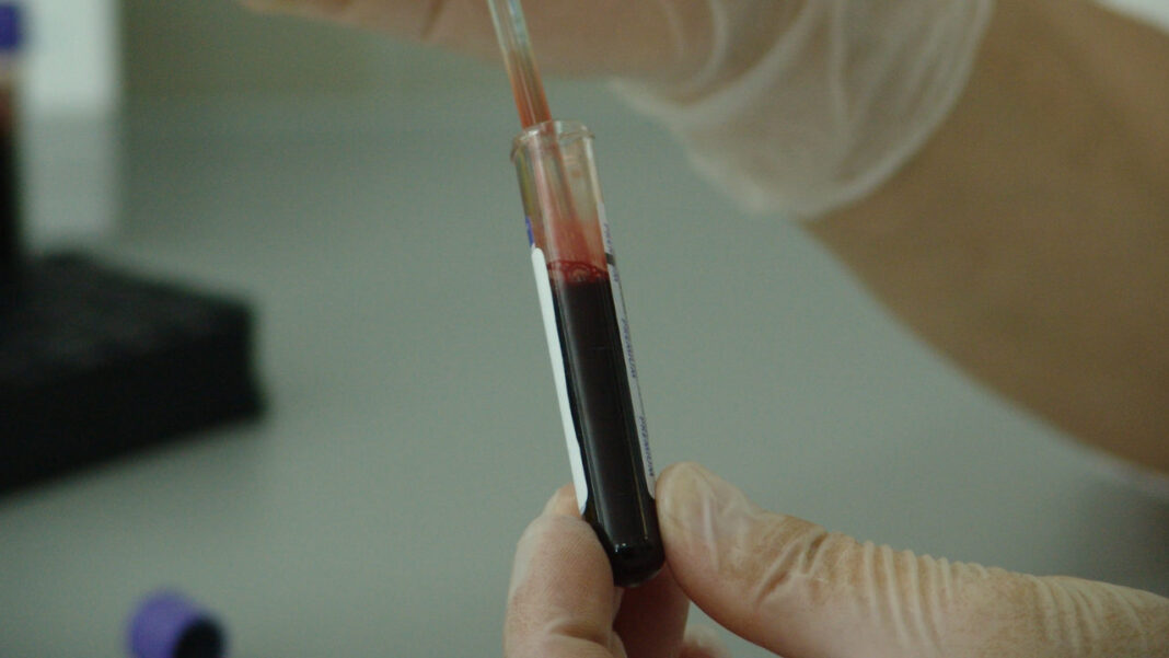 New Blood Test for Glioblastoma Could Replace Risky Brain Surgery, Researchers Say New Blood Test for Glioblastoma Could Replace Risky Brain Surgery, Researchers Say