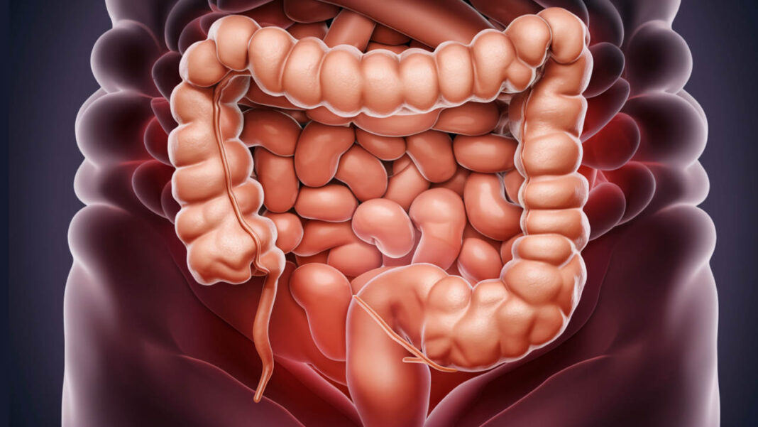Why Is Colon Cancer Rising in People Under 50? Scientists Discover How Gut Bacteria Triggers the Disease