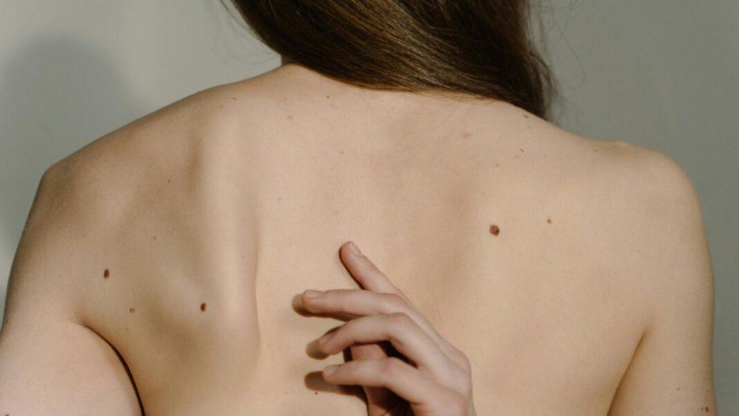 Could a “Smart Tattoo” Detect Skin Cancer Before It Appears?