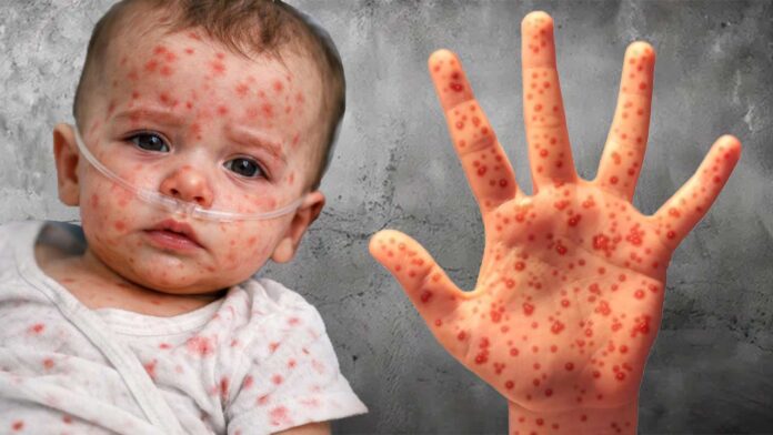 Bangladesh health system under pressure: Measles outbreak kills 500+ children!