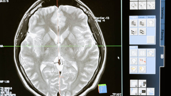 Do Younger Brains Really Recover Better Than Older Brains After Traumatic Injury? New Study Says Not So Fast